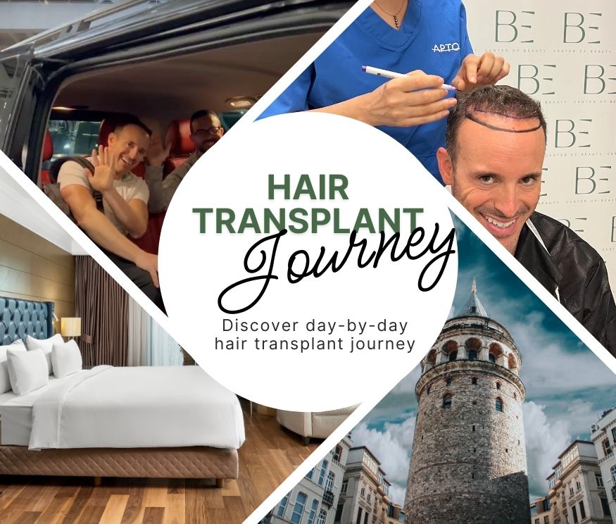 4 Magical Days Hair Transplant Journey: Each day of your four-day hair transplantation journey has been meticulously scheduled for your convenience. From the initial consultation to the final check-up, each stage is thoughtfully crafted to guarantee your comfort and contentment. Your journey to renewed confidence and a fuller head of hair is not just a procedure—it’s a comprehensive experience tailored just for you.